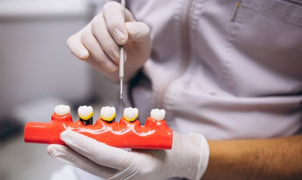İmplant Tedavileri (Dental Implantoloji)